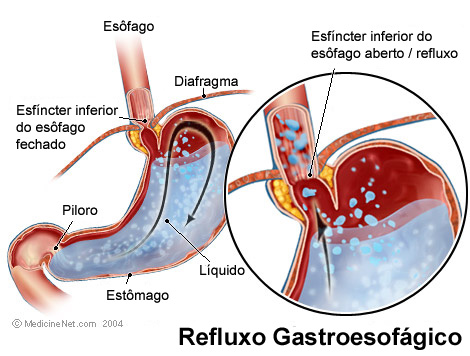 refluxo como evitar