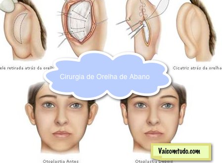 cirurgia orelha de abano