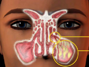 sinusite-sinuplastia-2