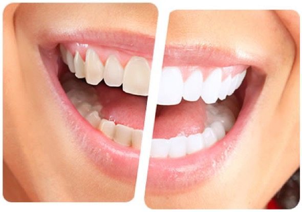 1-clareamento dental