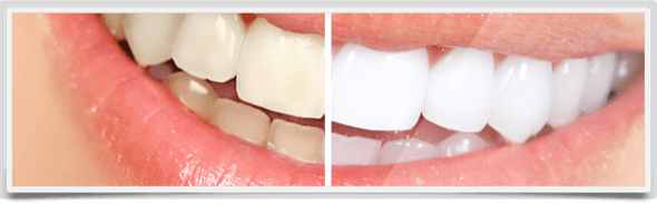 3-clareamento dental