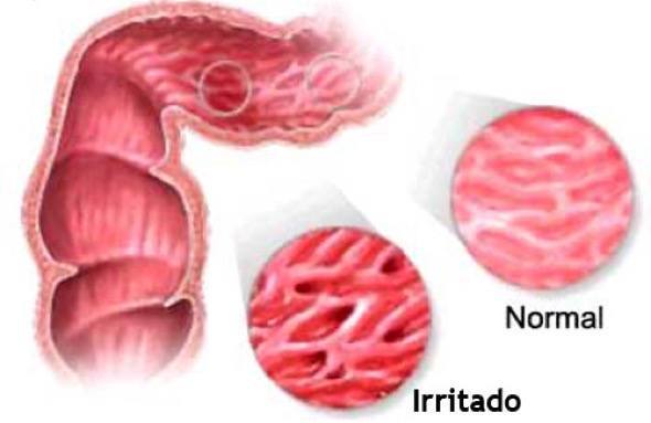 2-sindrome do intestino irritavel