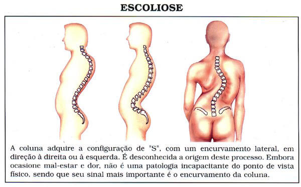 Escoliose