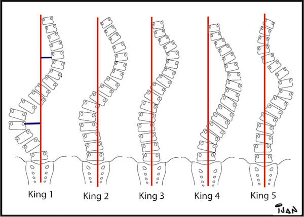 Escoliose2