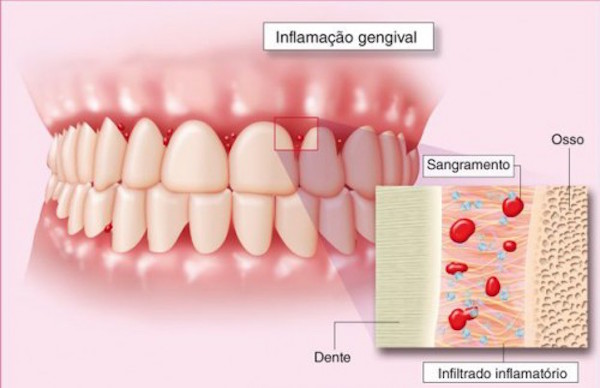 Acabar Com Dor Na Gengiva2