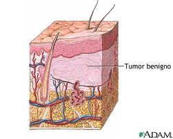 o que é tumor benigno 2