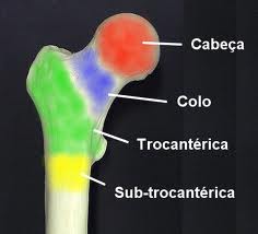 nivel da fratura no femur