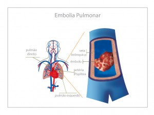 Como Acontece a Embolia Pulmonar