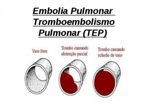 Como Acontece a Embolia Pulmonar 2